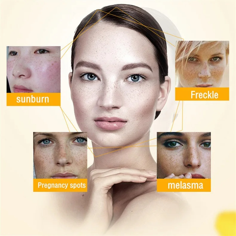 Whitening Freckle Cream Remove - Skincare Glowing review and price