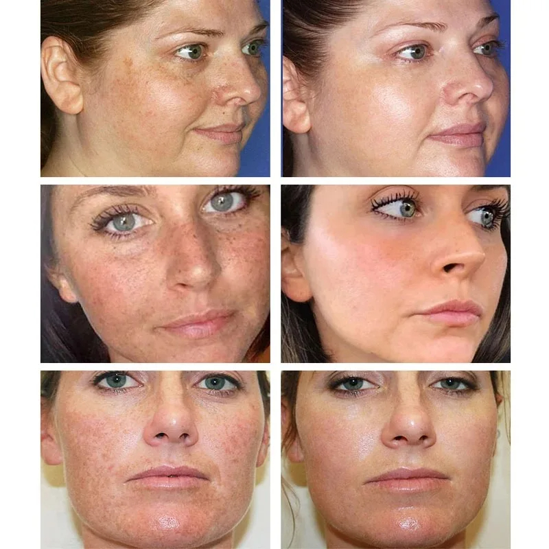 Whitening Freckle Cream Remove - Skincare Glowing review and price
